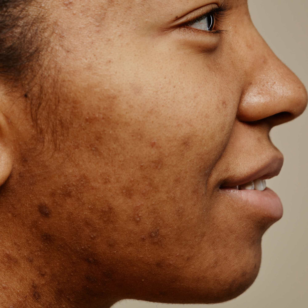 Hyperpigmentation Xample What is hyperpigmentation? – indu Beauty